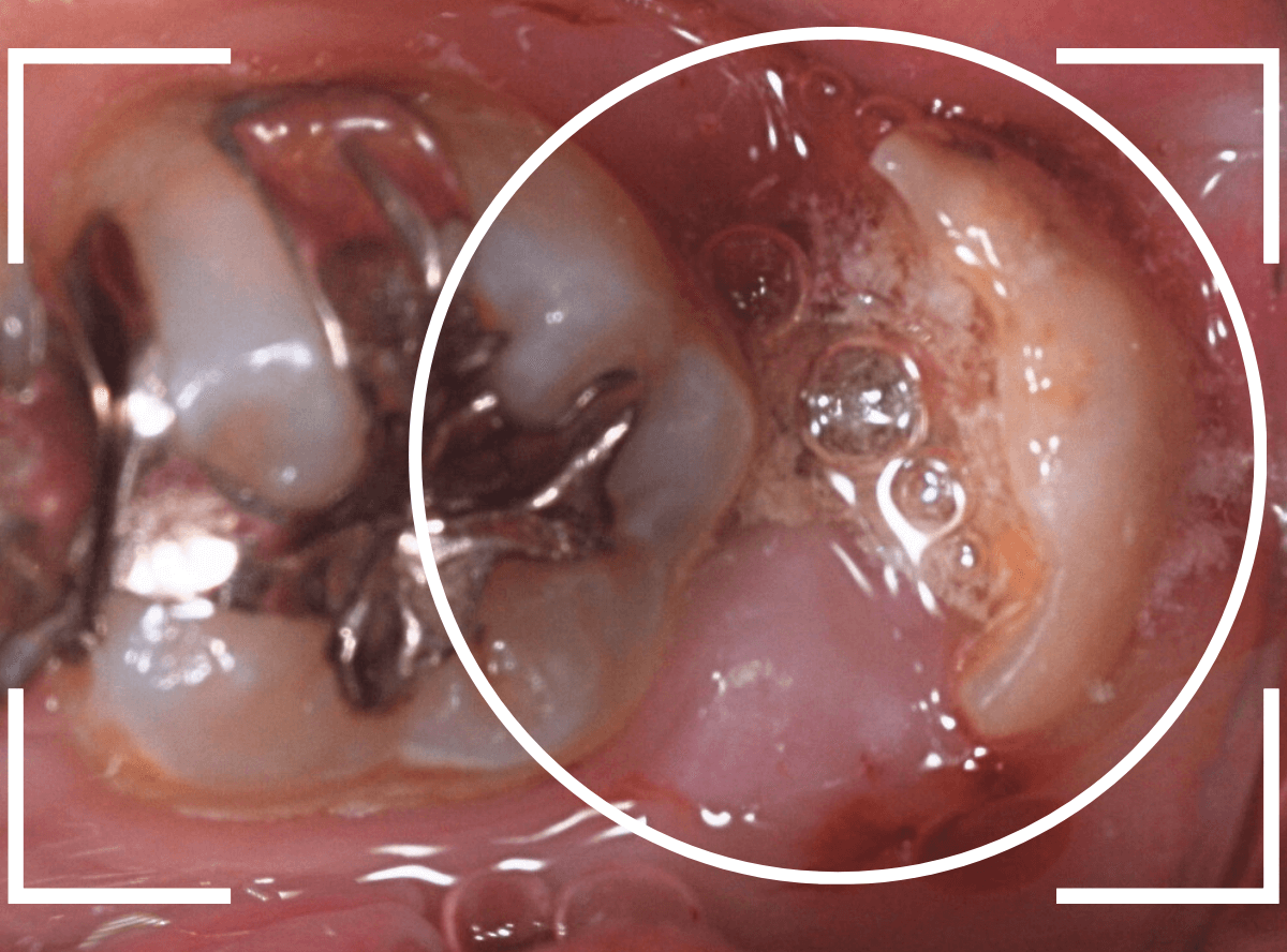 おやしらずの抜歯8-1
