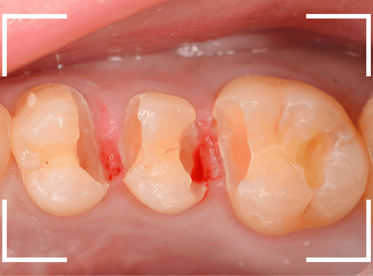 つめものの下の深い深い虫歯17-6