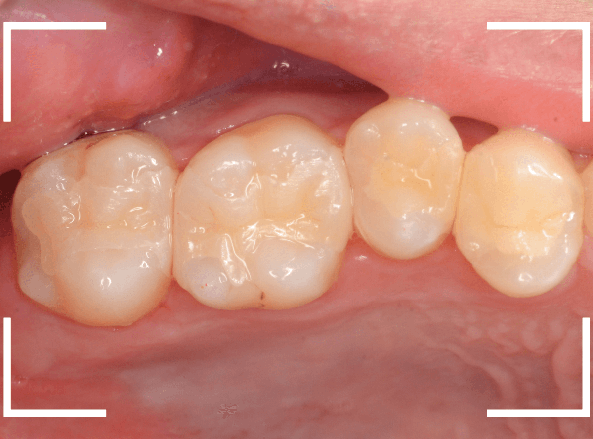 セラミック治療(インレー)34-5