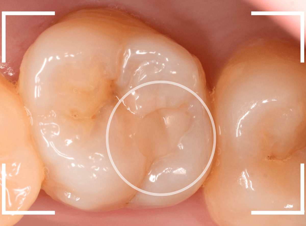 つめものの下の深い深い虫歯20-1