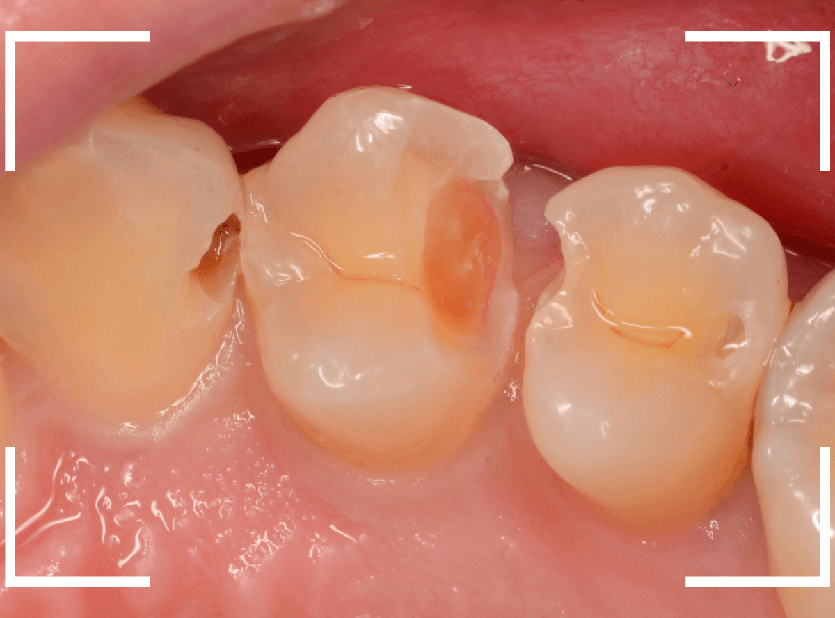 歯と歯の間の虫歯16-6