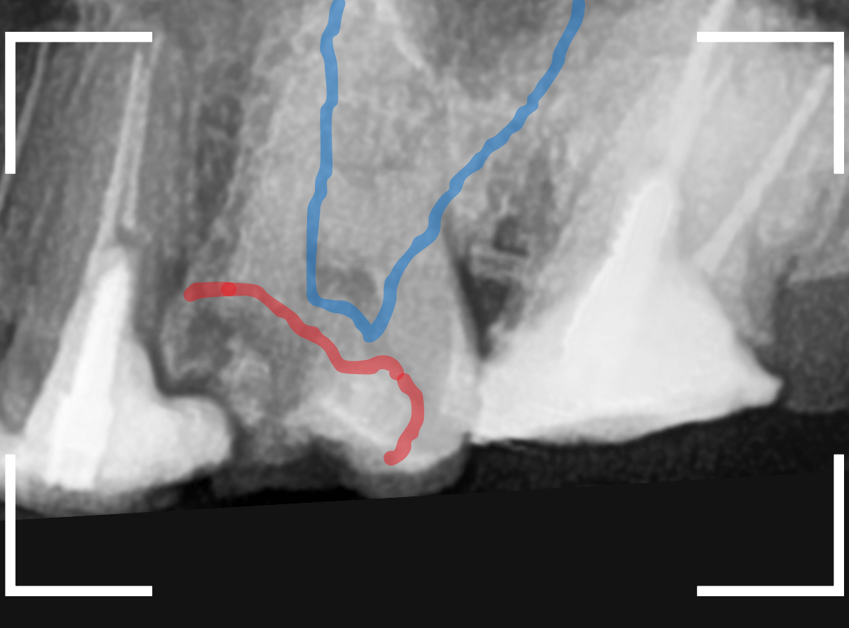 つめものの下の深い深い虫歯20-2