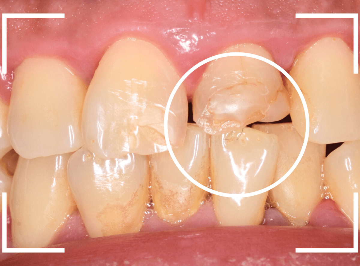 セラミック治療(前歯・クラウン)5-2