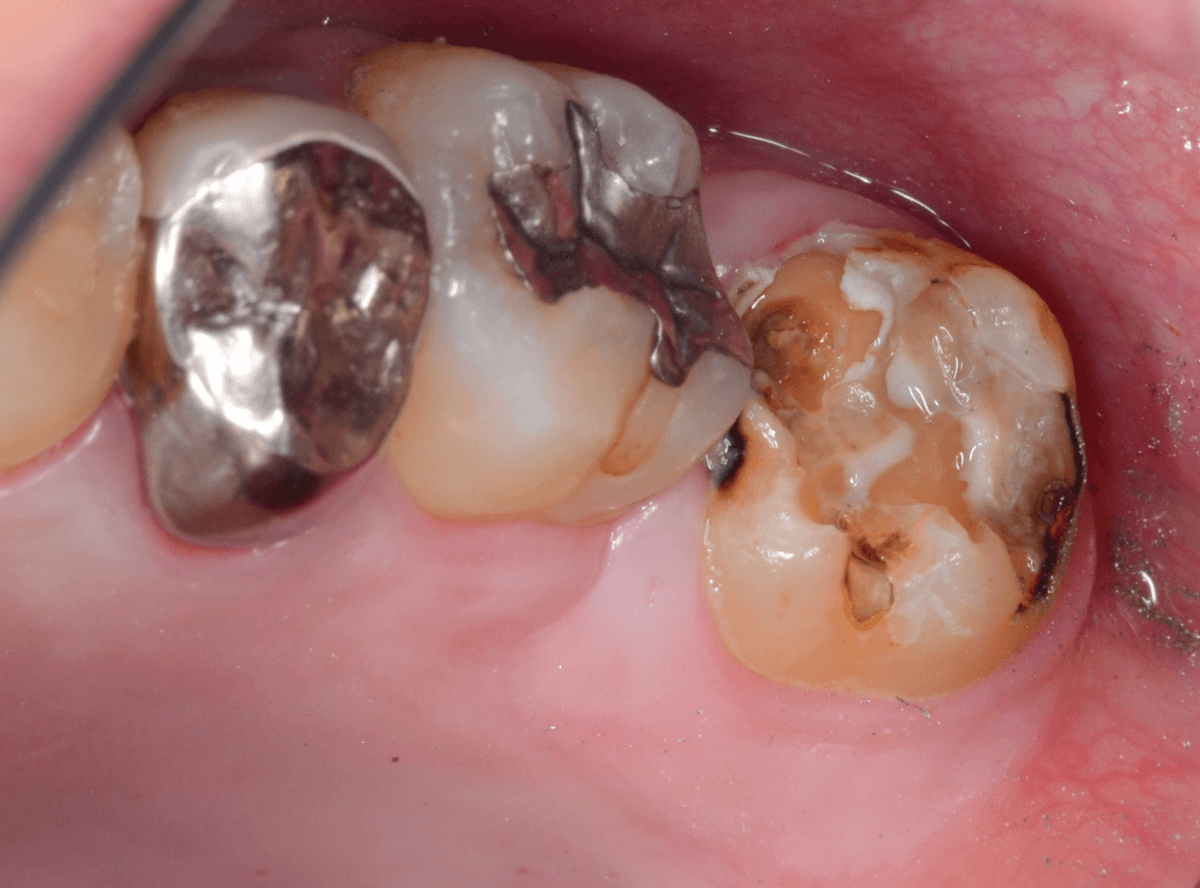 つめものの下の深い虫歯(画像)4-5