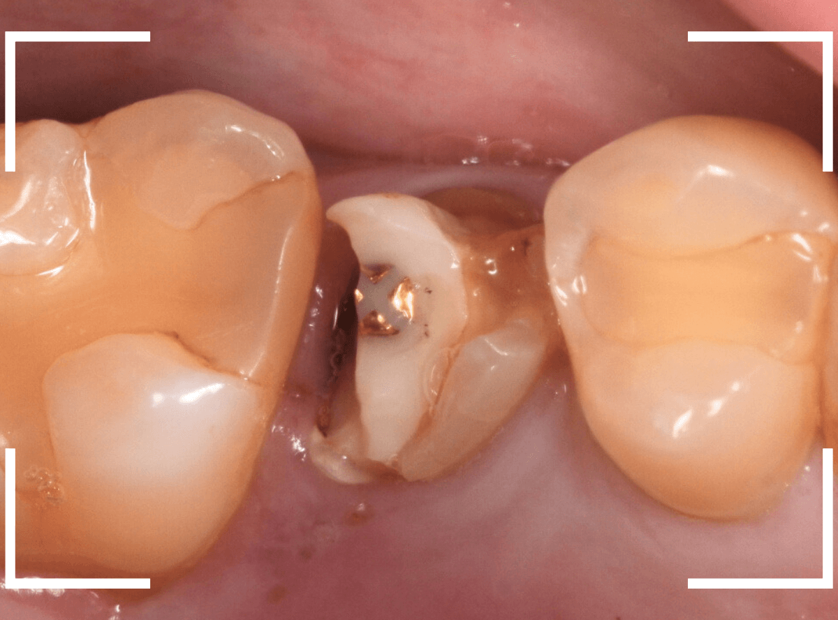 セラミック治療(クラウン・奥歯)8-1