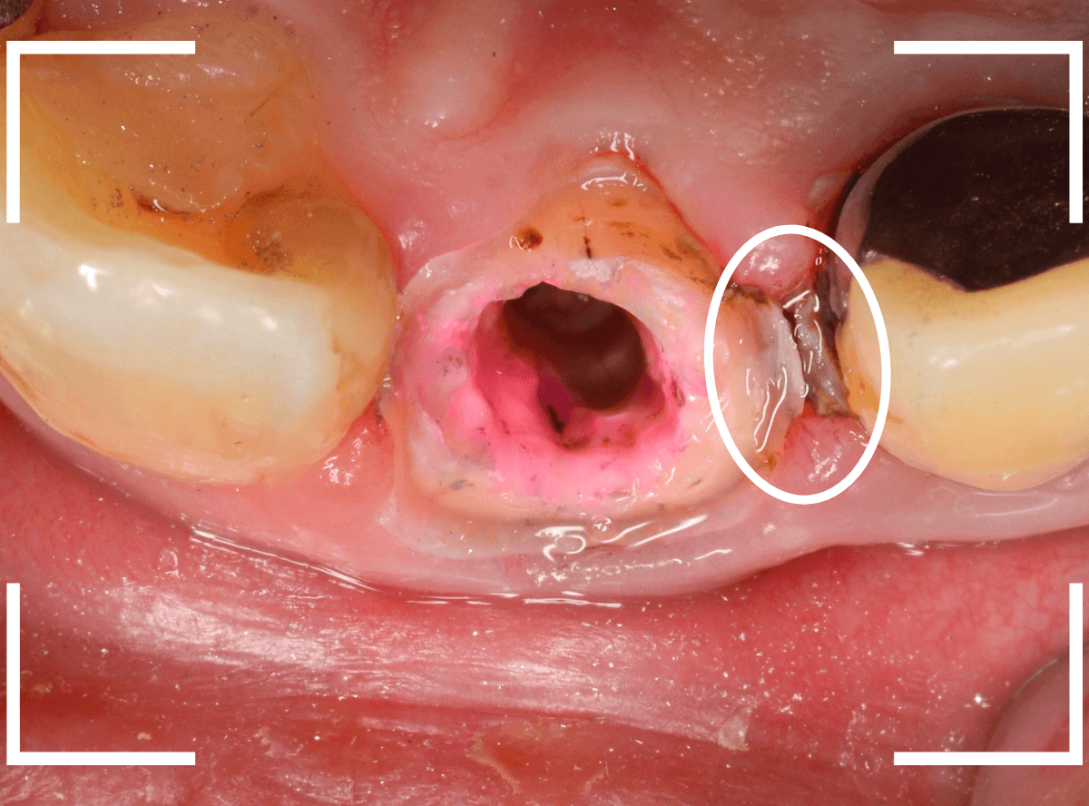 歯肉の中の歯石（歯肉縁下歯石）除去(画像）5-5