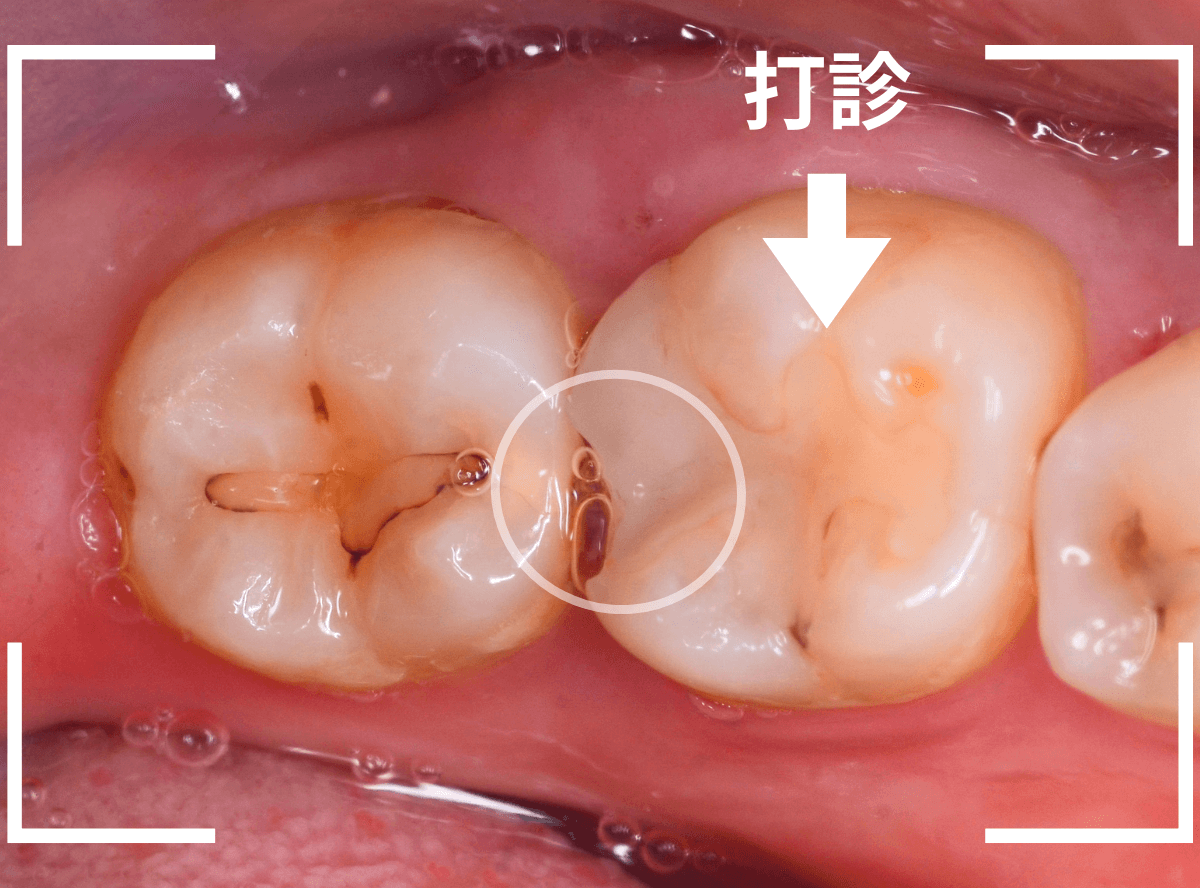 歯と歯の間の虫歯23-1