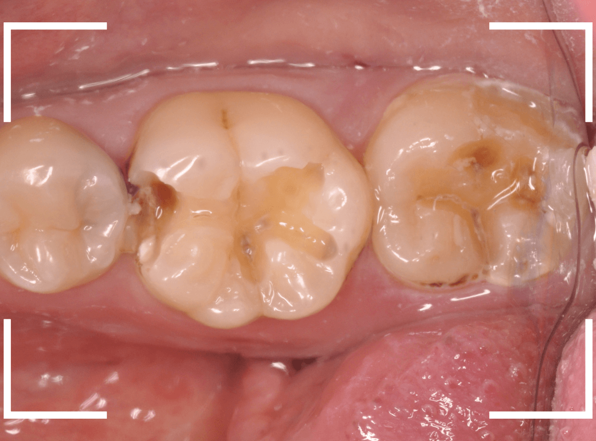 セラミック治療(インレー)30-2