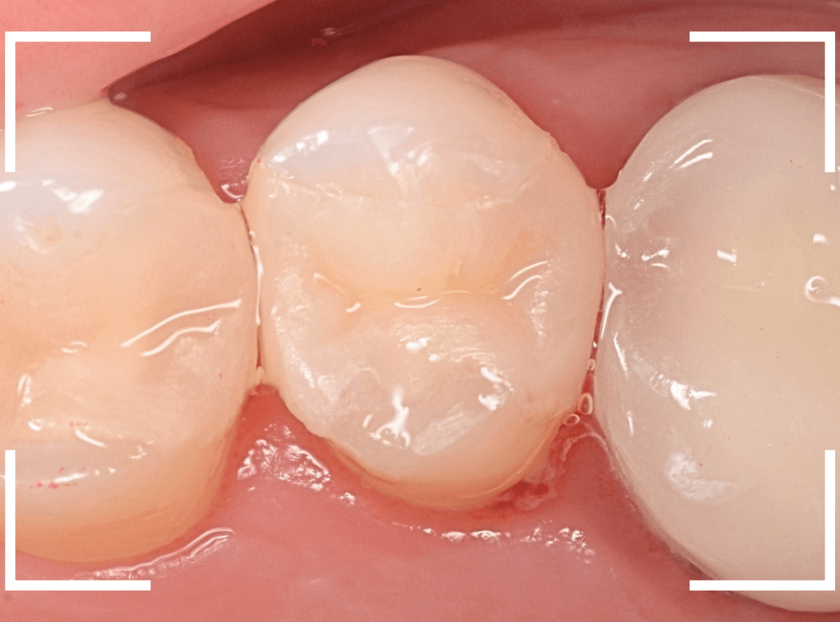 セラミック治療(インレー)22-4