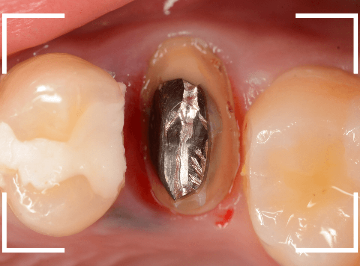 セラミック治療(クラウン・奥歯)9-2