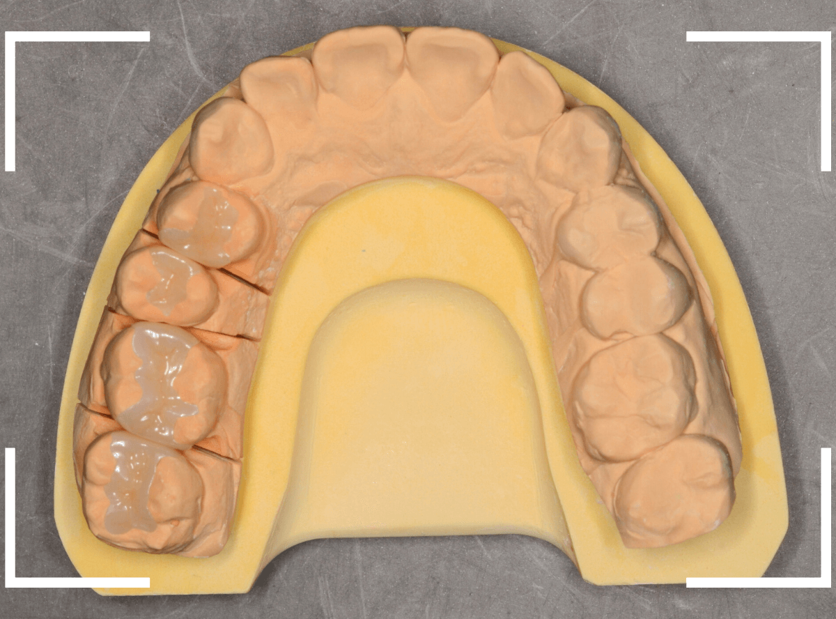 セラミック治療(インレー)34-3