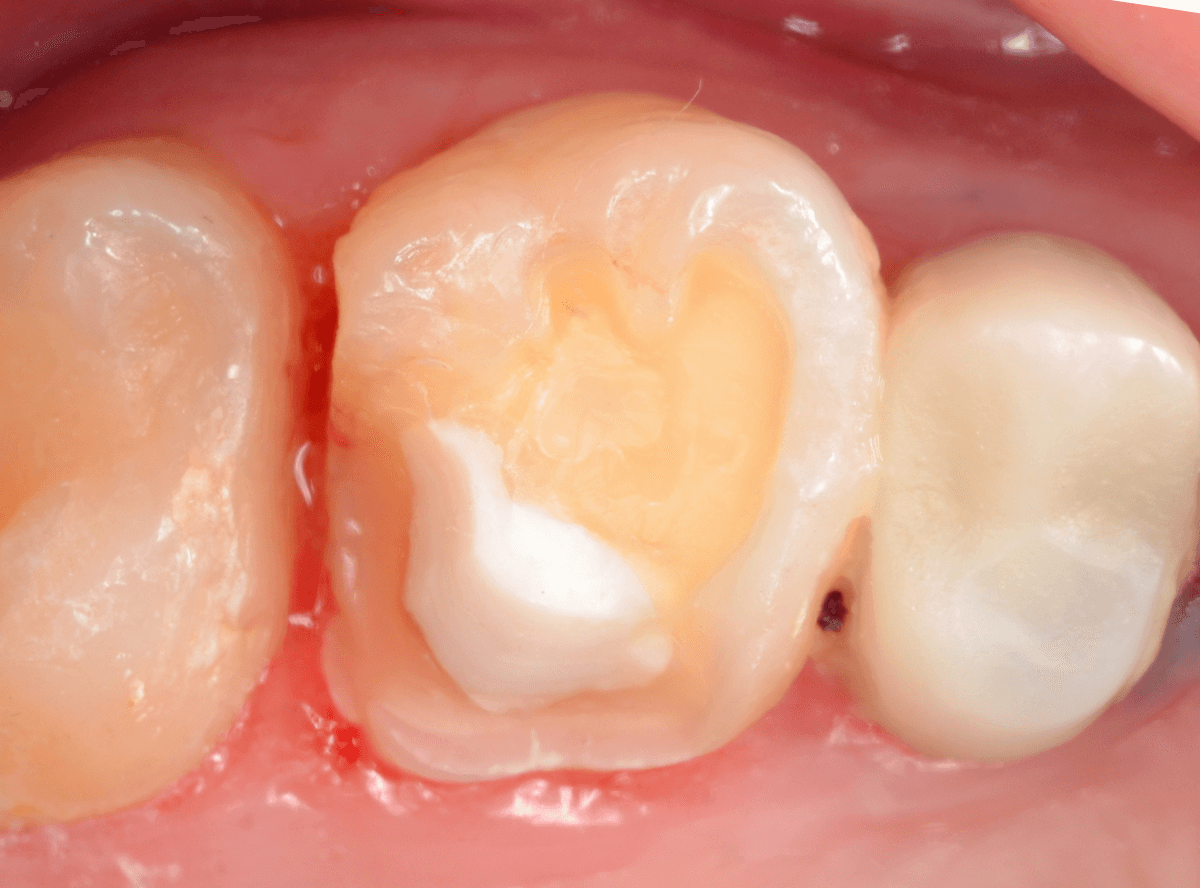 セラミック治療(インレー)2-1