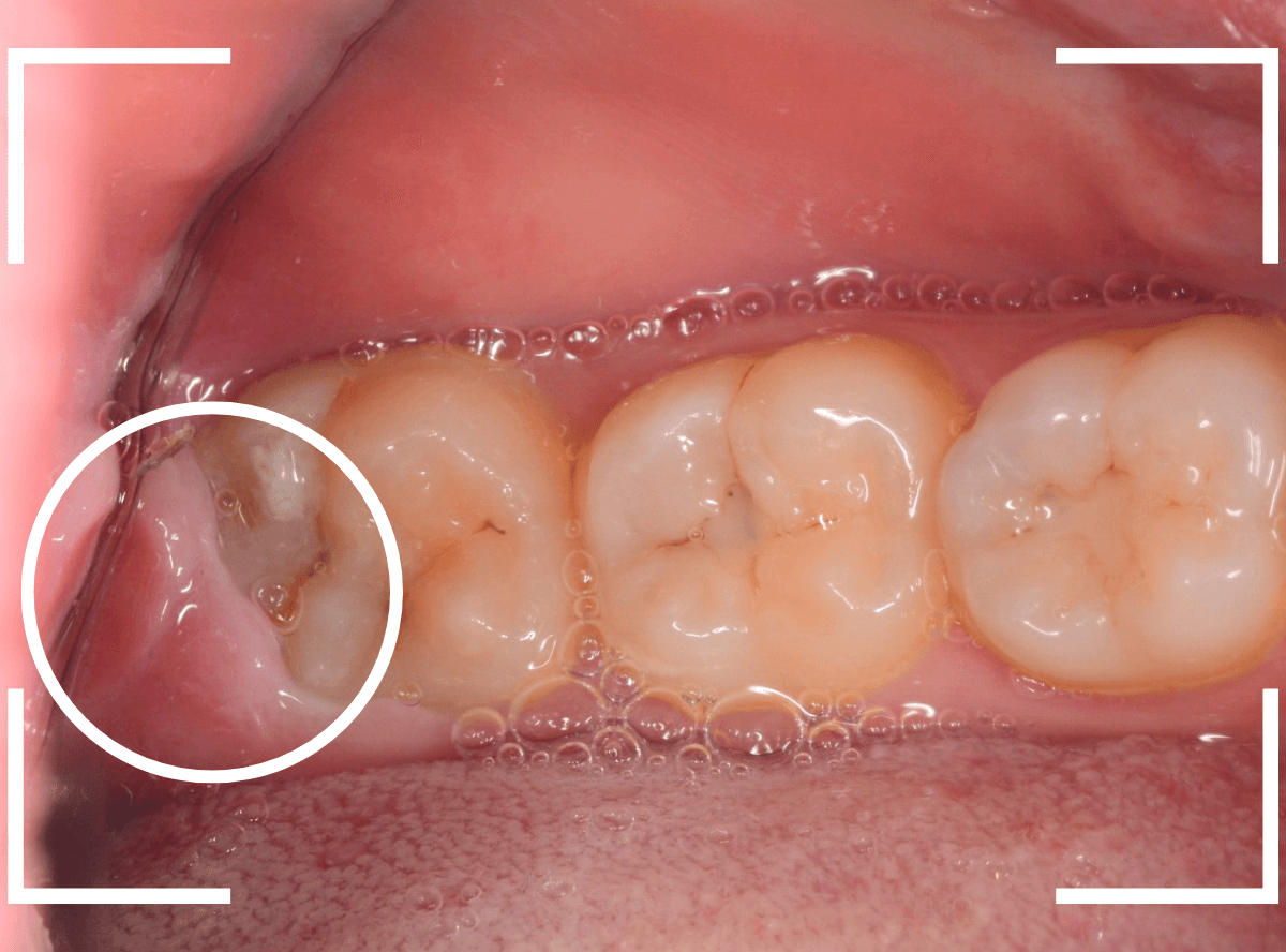 おやしらずの抜歯14-1