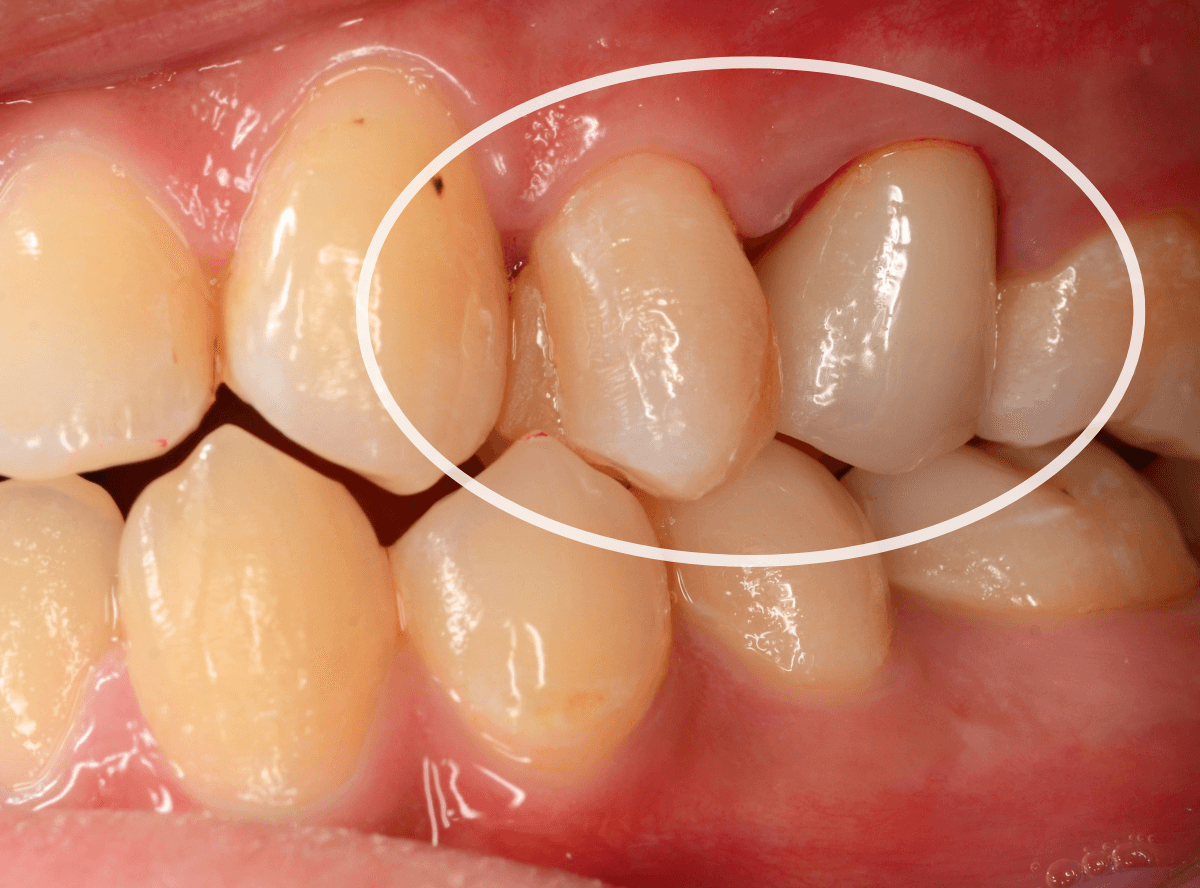 セラミック治療(クラウン・奥歯)9-10