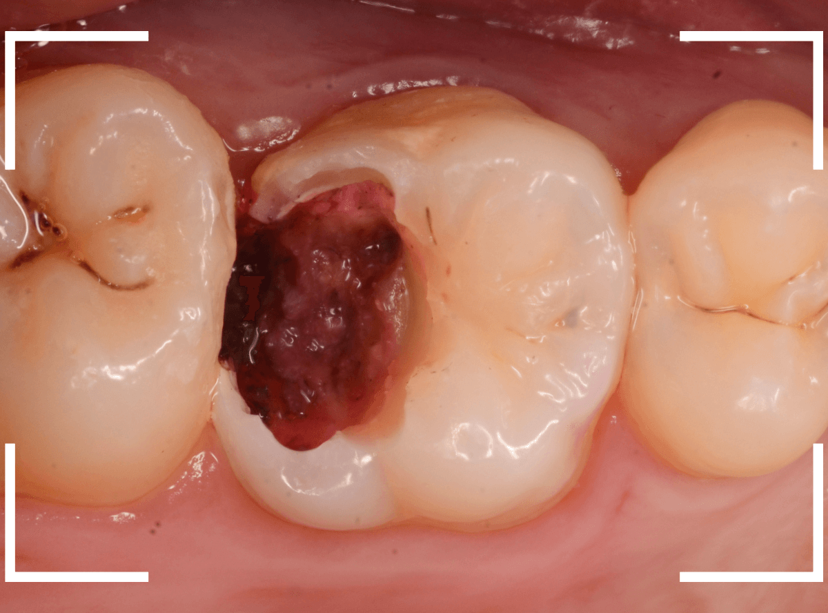 つめものの下の深い深い虫歯20-1