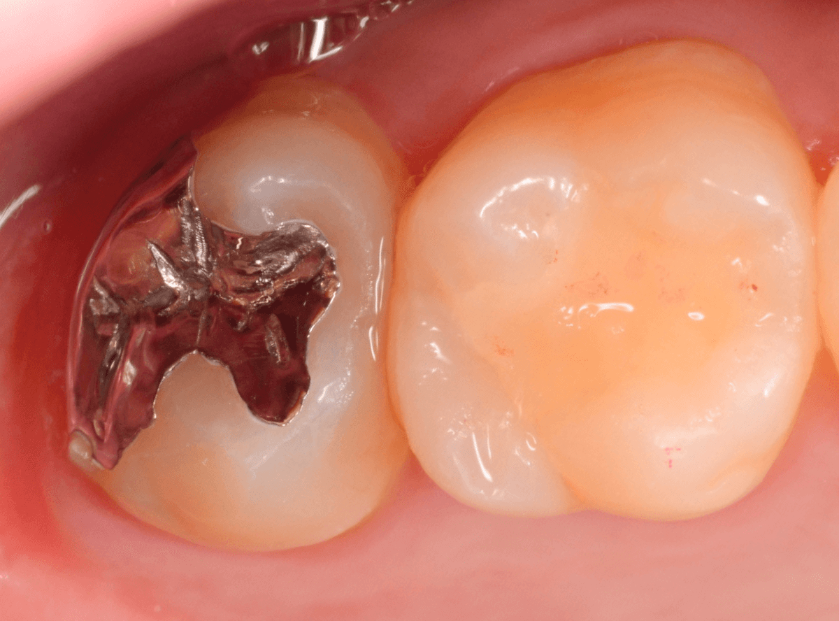気づかないうちに深い虫歯1-7