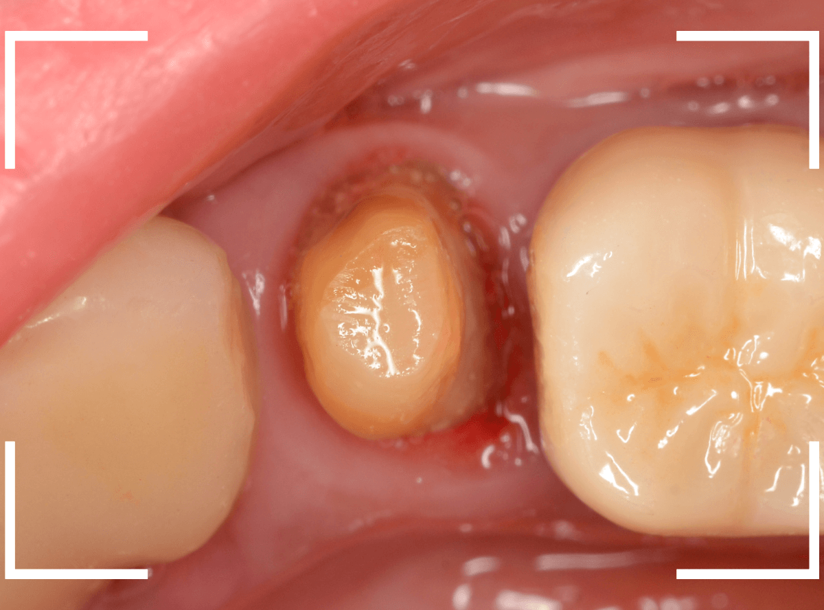 セラミック治療(クラウン・奥歯)8-3