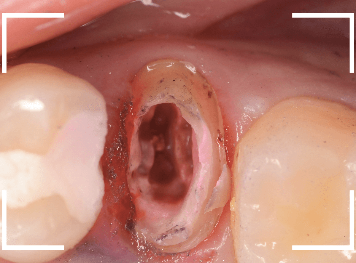 セラミック治療(クラウン・奥歯)9-4