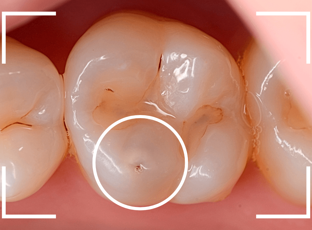 レントゲンでわかりづらい虫歯8-1