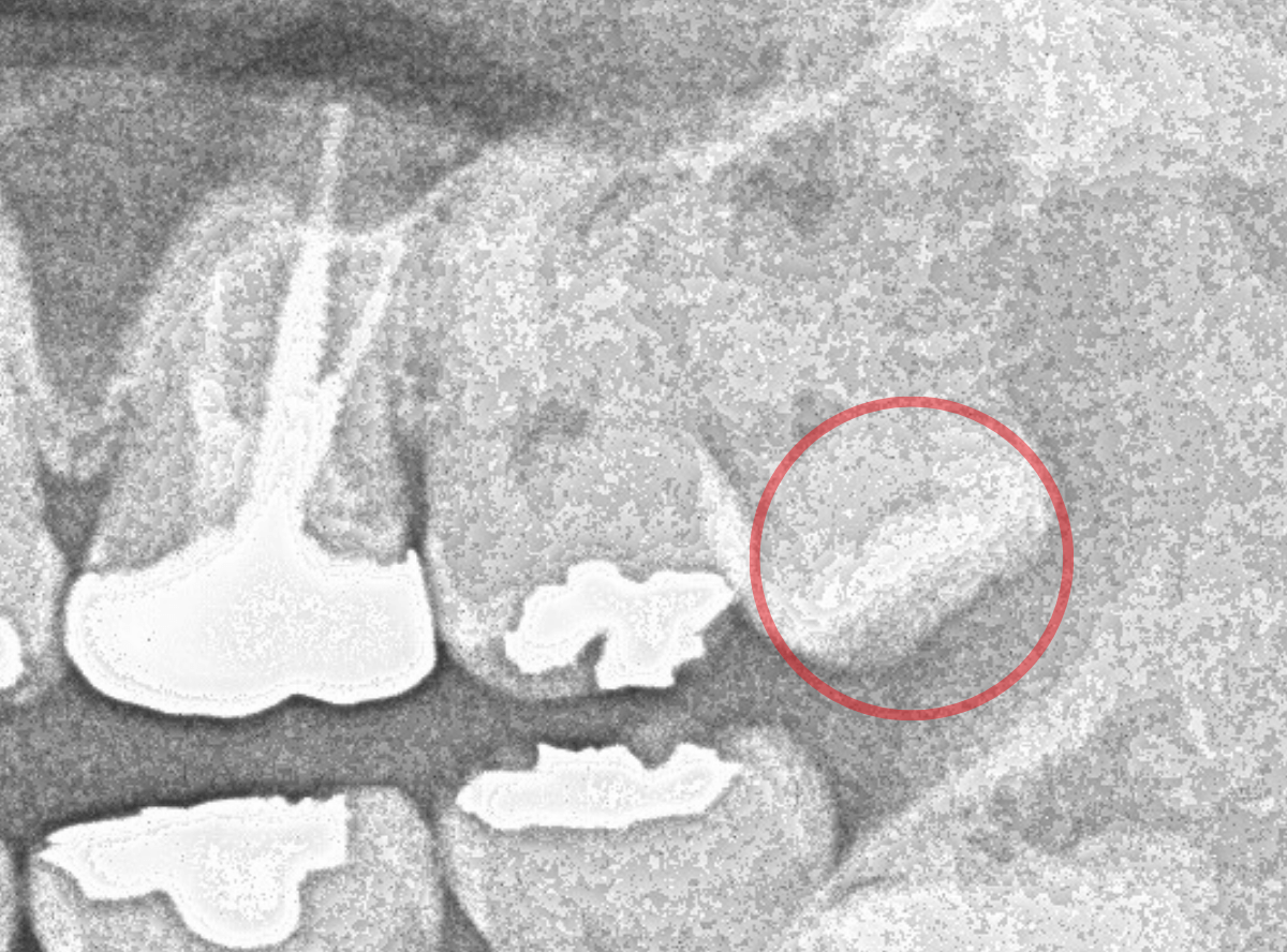 おやしらずの抜歯4-1