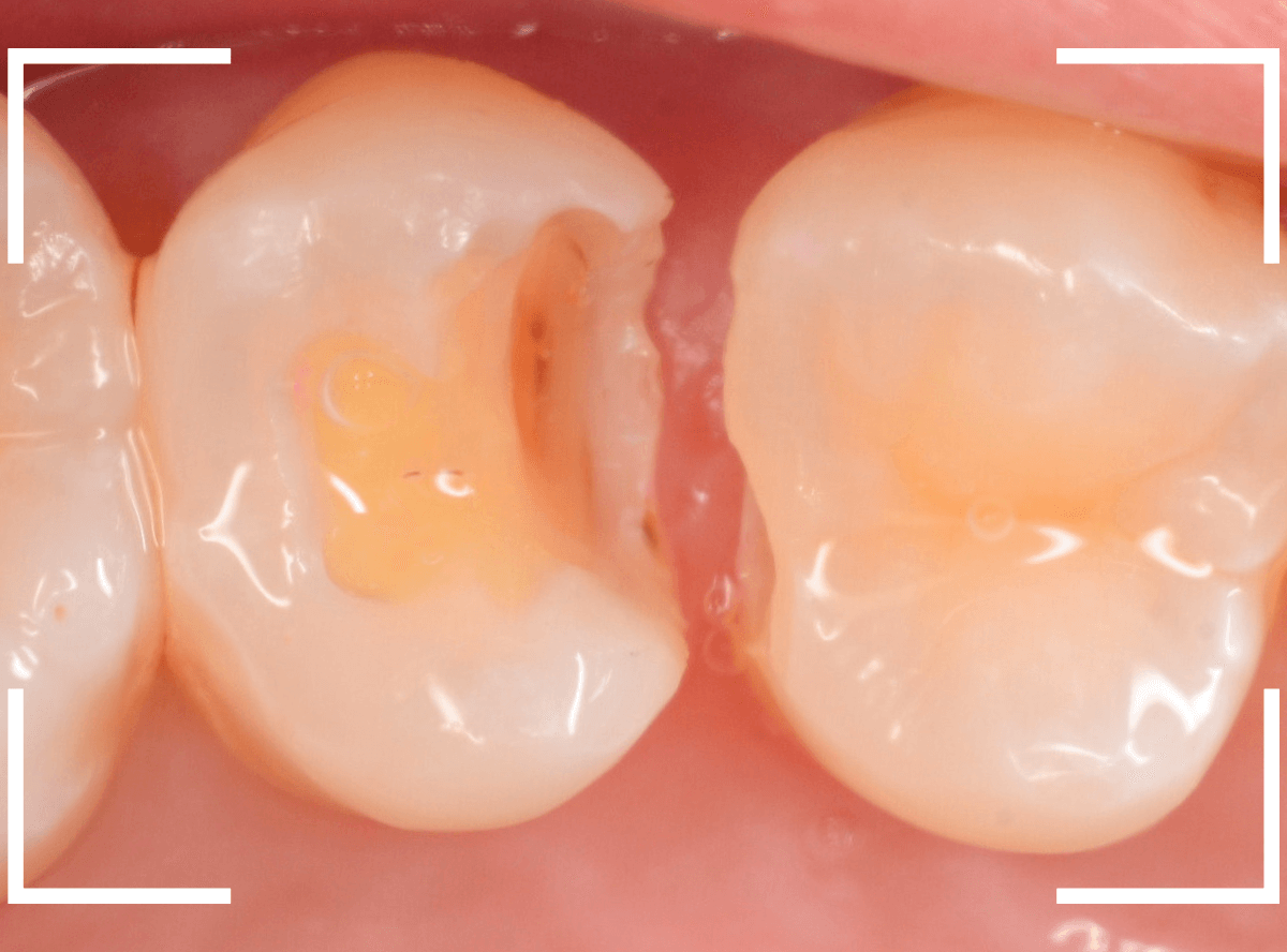 セラミック治療(インレー)27-5