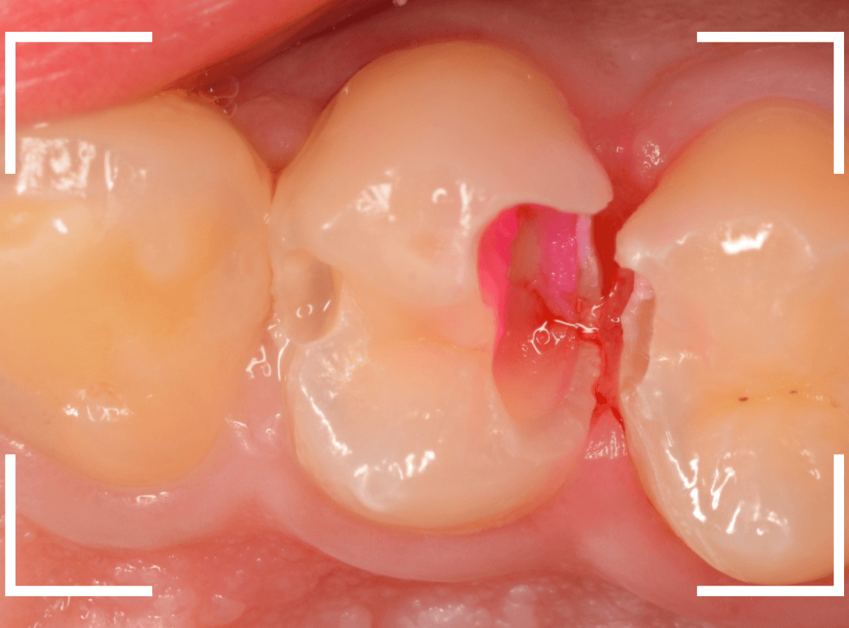 歯と歯の間の虫歯19-4