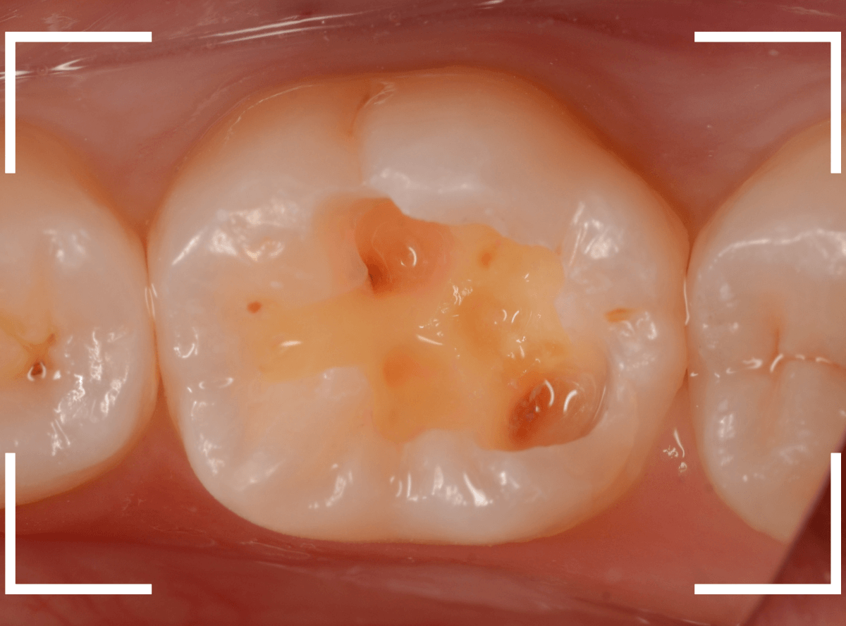 レントゲンでわかりづらい虫歯16-3