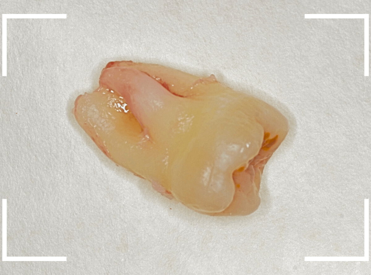 おやしらずの抜歯10-3