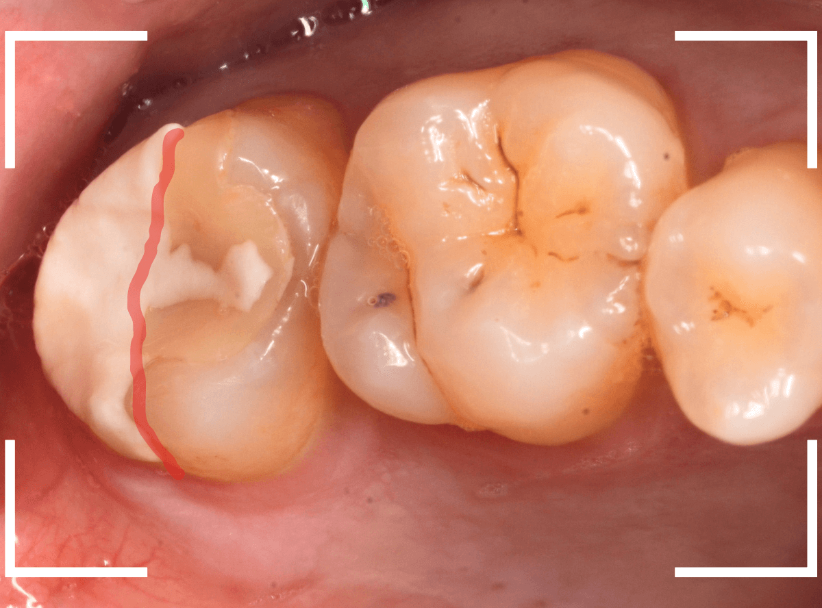セラミック治療(インレー)31-1