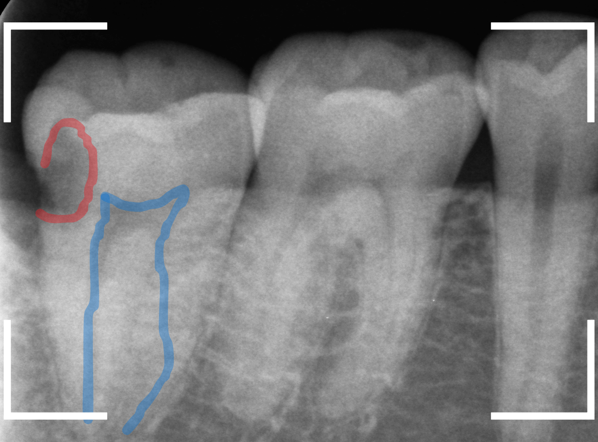 気づかないうちに深い虫歯12-2
