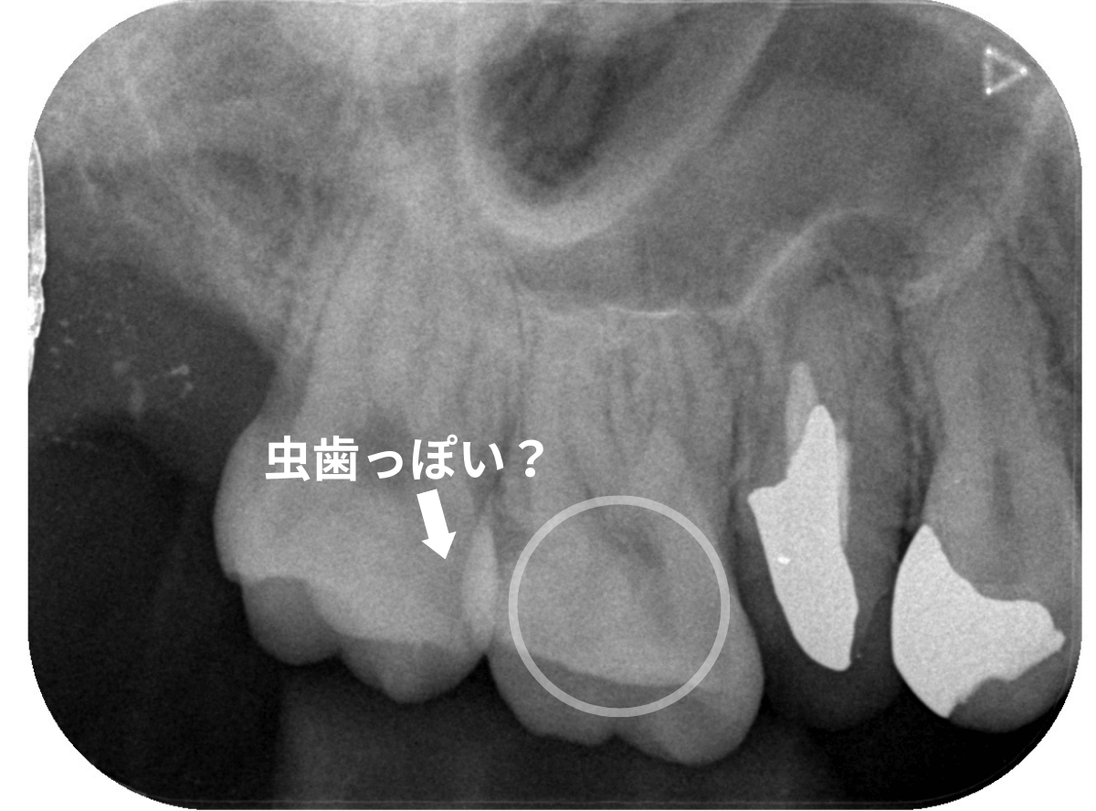 レントゲンでわかりづらい虫歯1-2