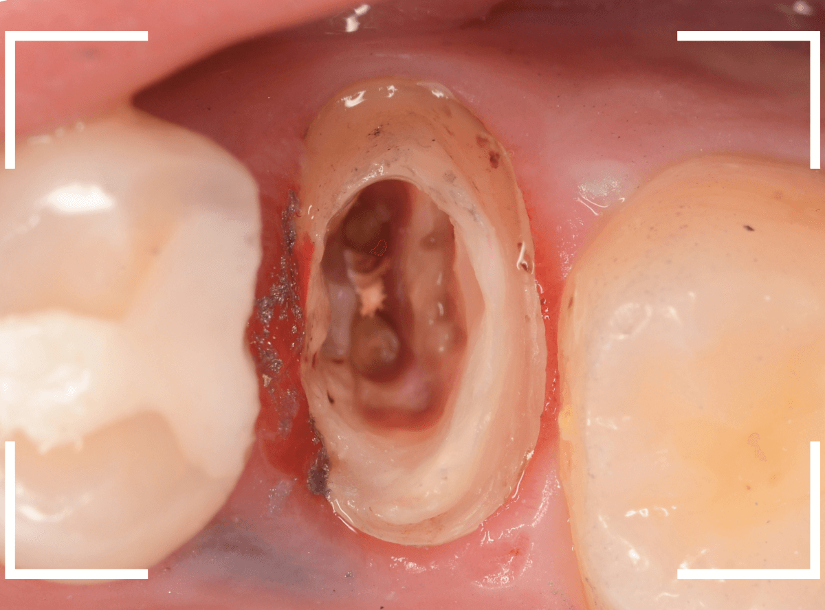 セラミック治療(クラウン・奥歯)9-5