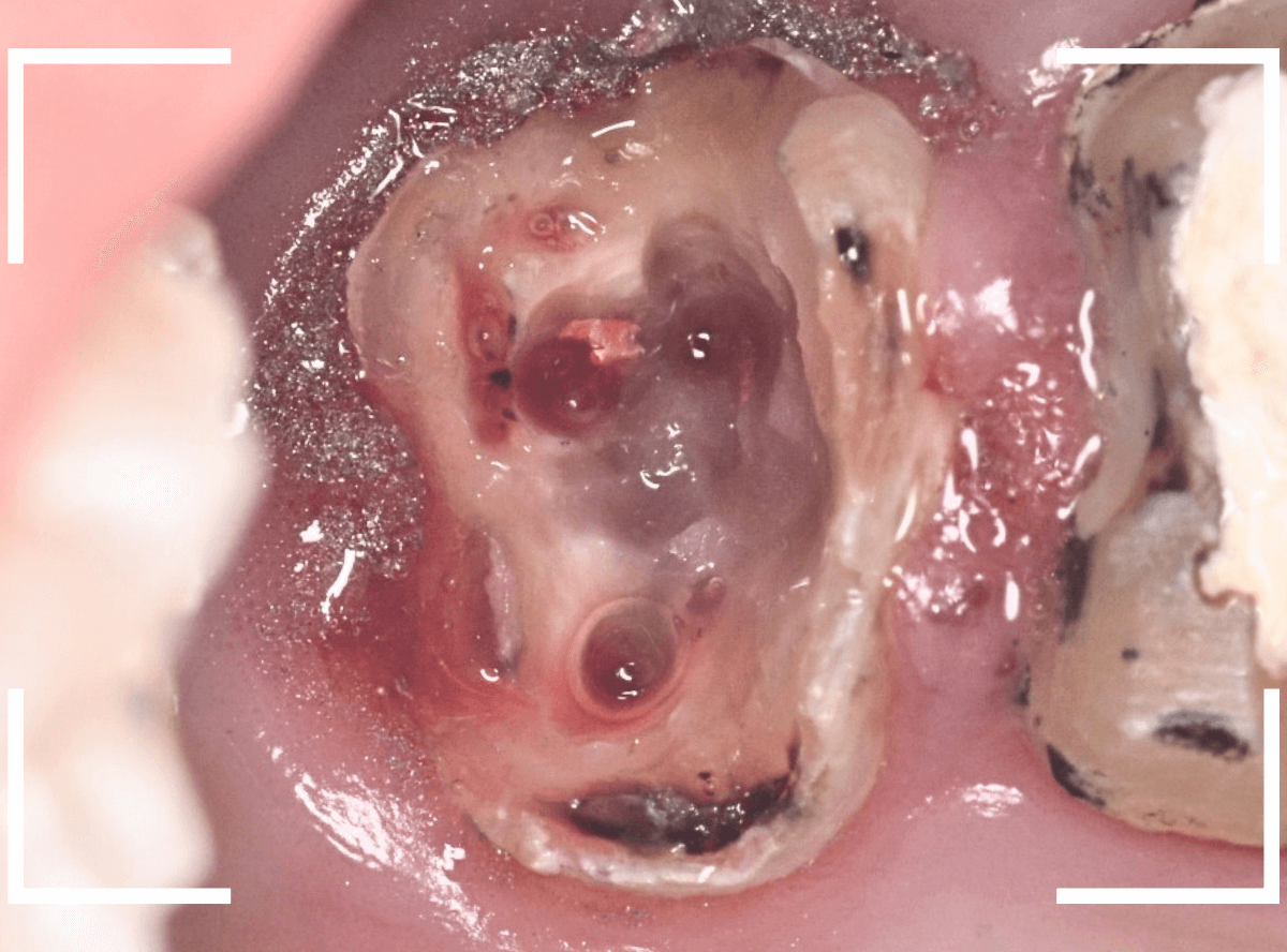歯の土台の再治療2-2