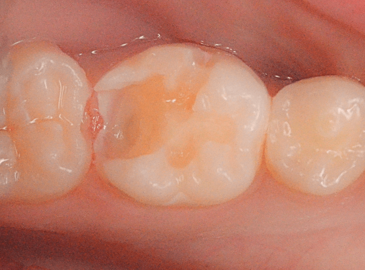 セラミック治療(インレー)7-4