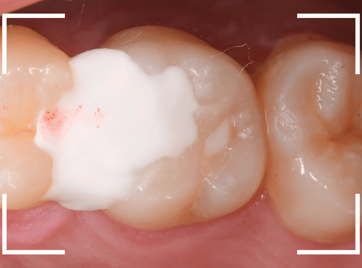 気づかないうちに深い虫歯4-6