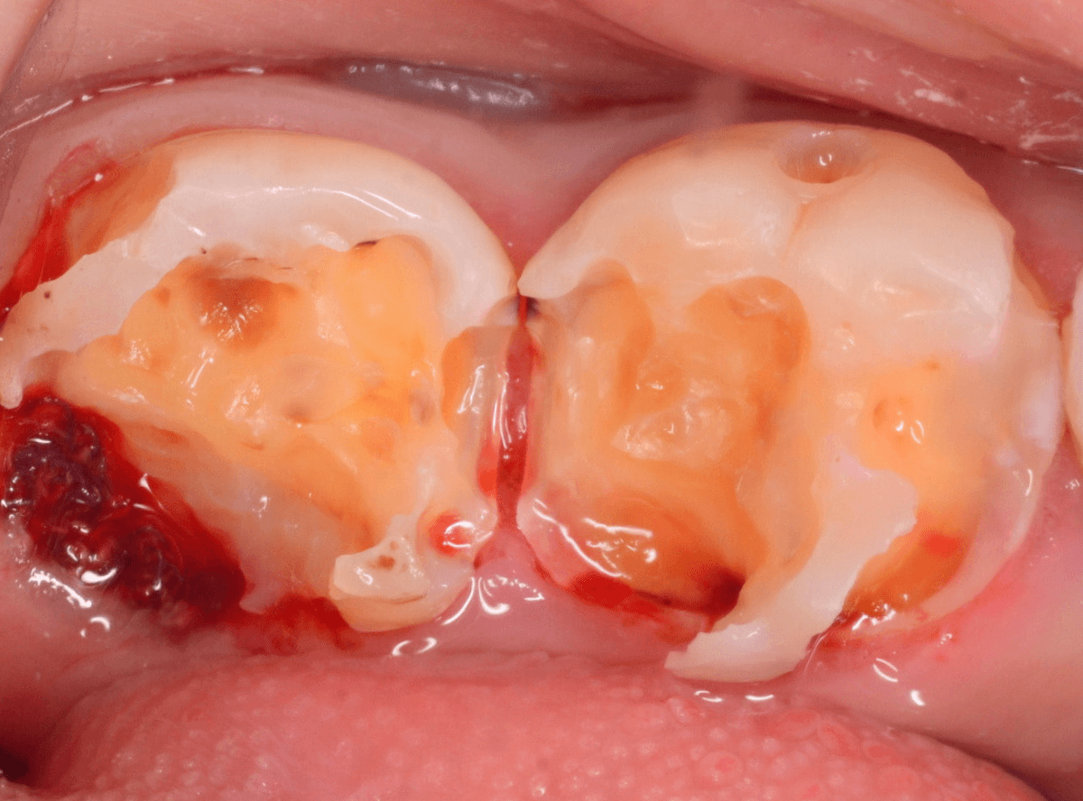 つめものの下の深い深い虫歯11-1