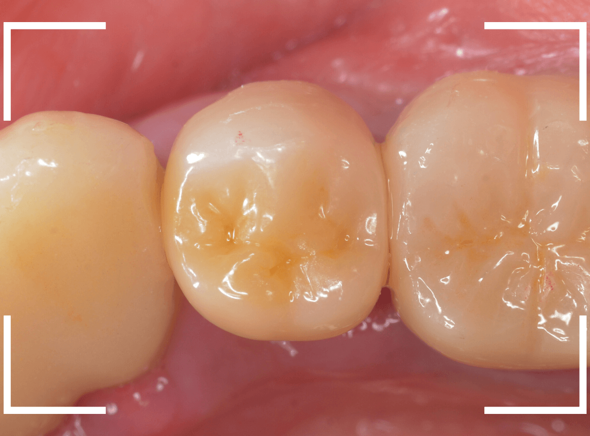 セラミック治療(クラウン・奥歯)8-5