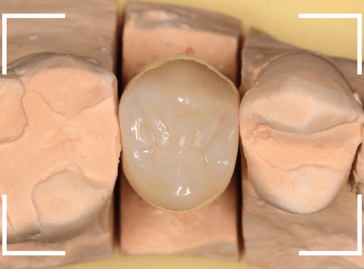 セラミック治療(クラウン・奥歯)8-7