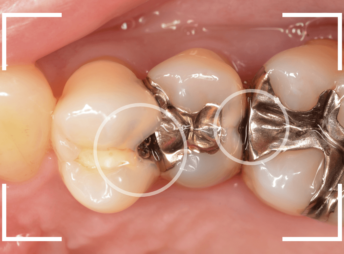 歯と歯の間の虫歯21-1