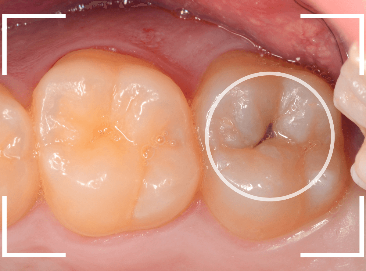 小窩裂溝う蝕4-1