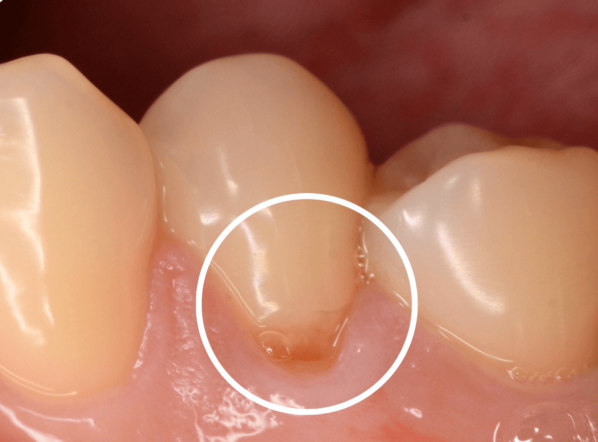 知覚過敏の画像5-1