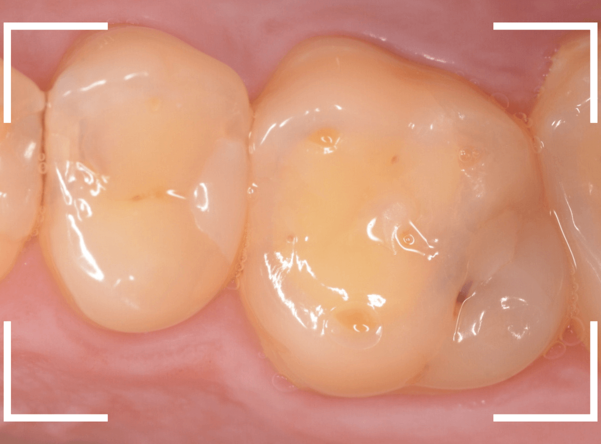 セラミック治療(インレー)24-1