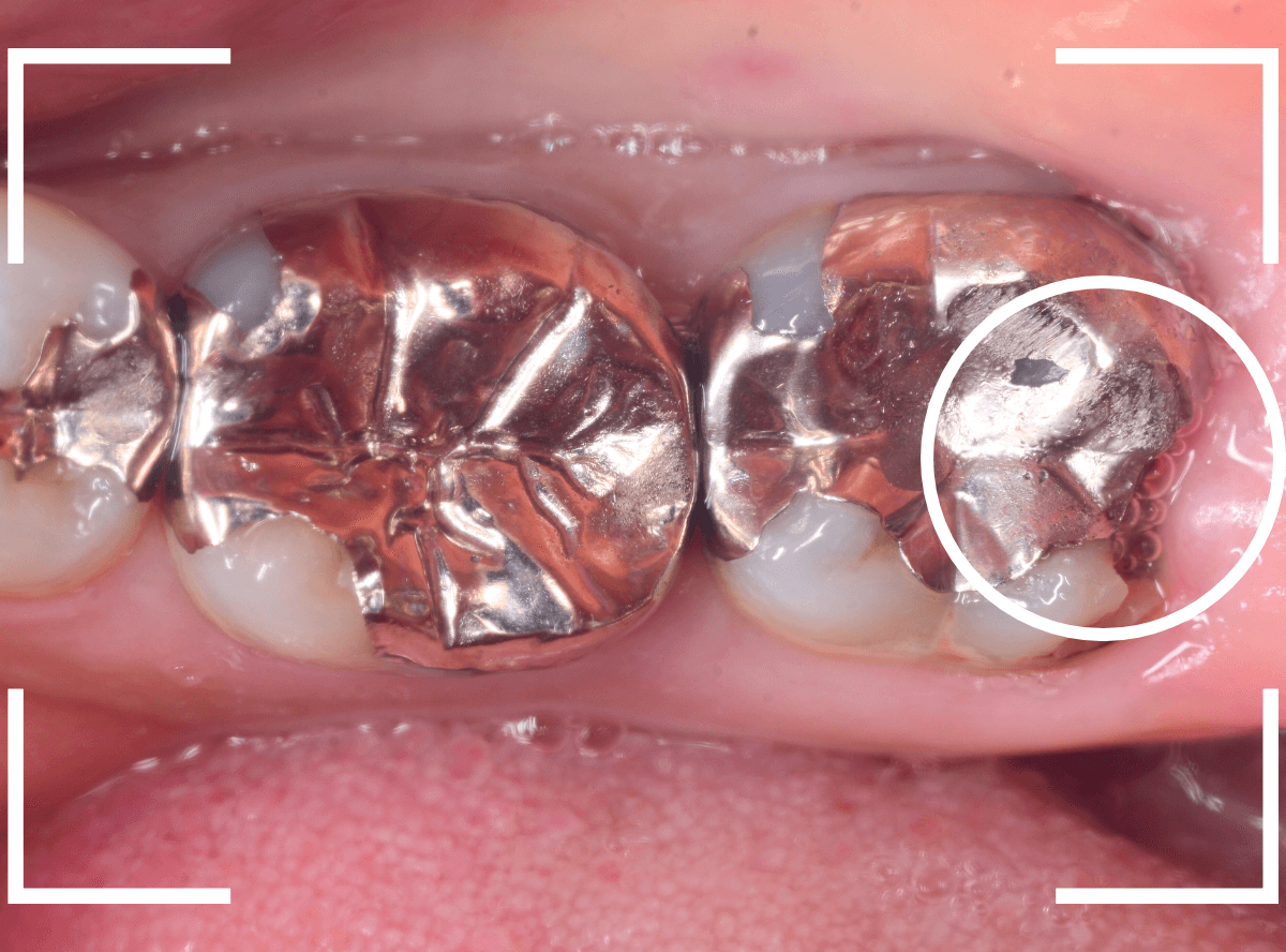 つめものの下の深い虫歯(画像)10-1