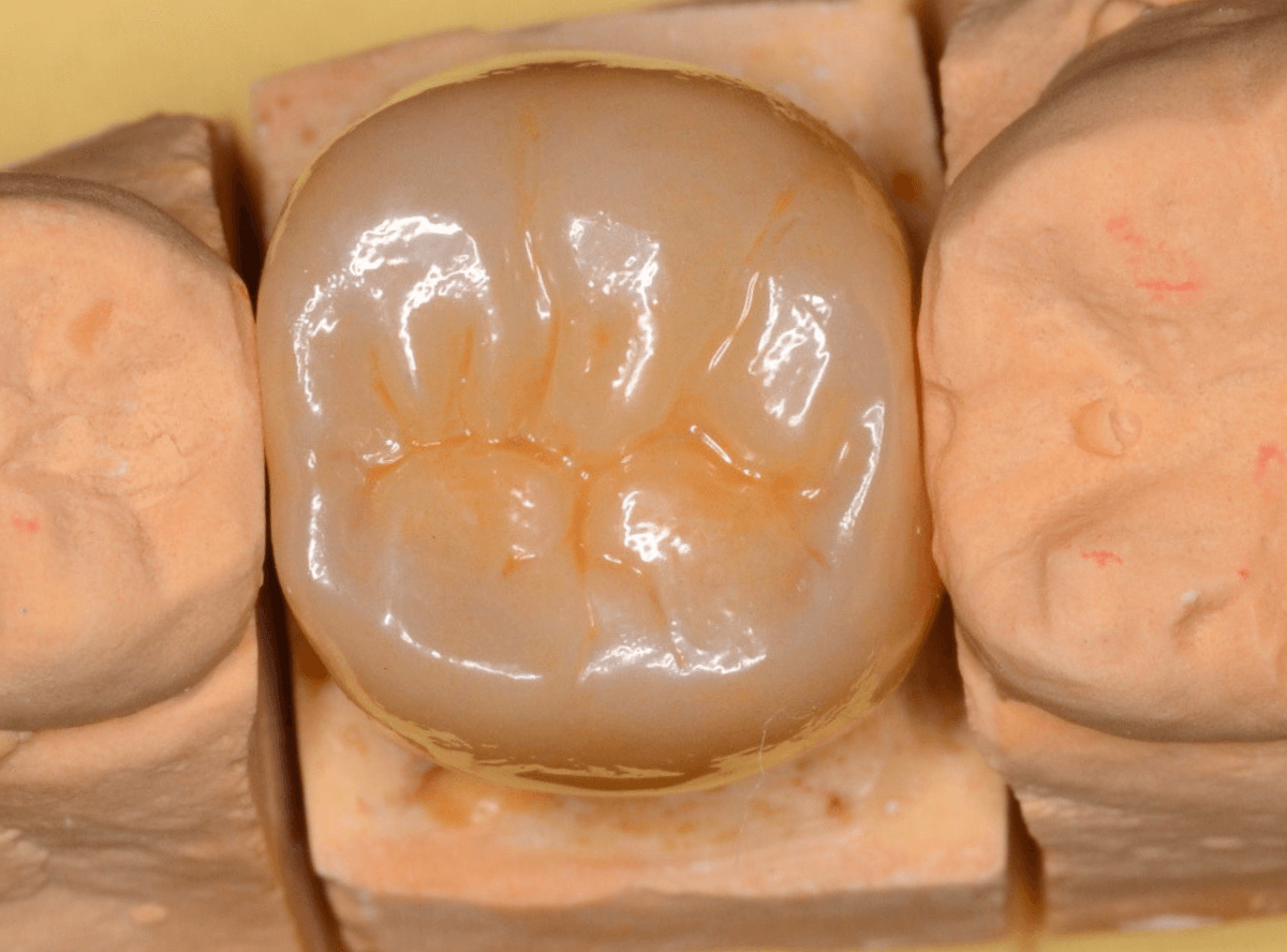 つめものが取れた歯の治療の画像-7