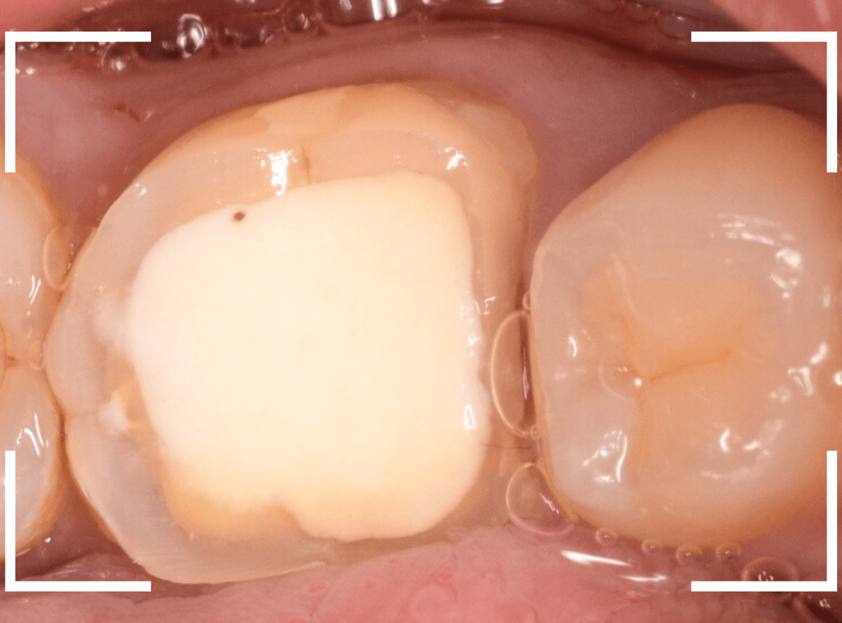 セラミック治療(クラウン・奥歯)9-1