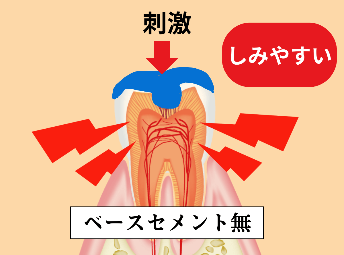 歯の治療の器具_ベースセメント-3