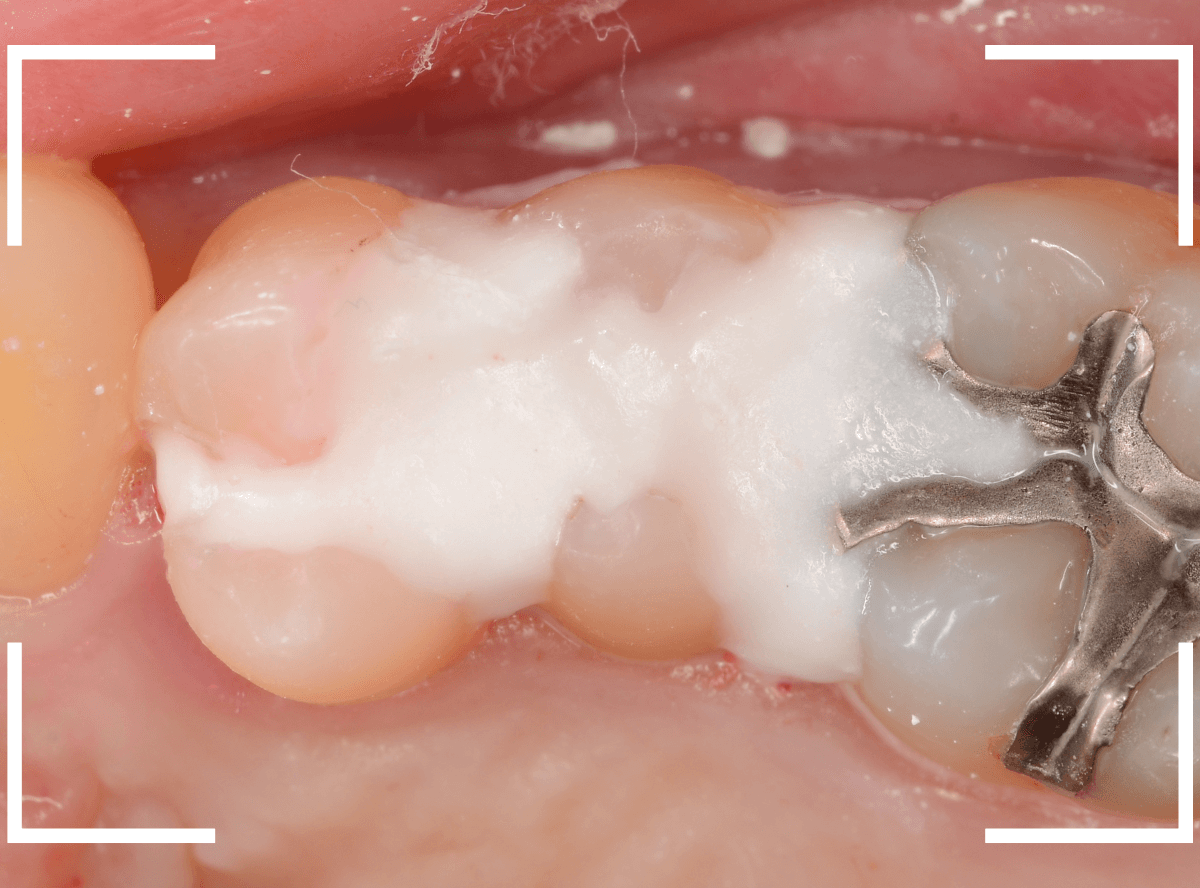 歯と歯の間の虫歯21-1