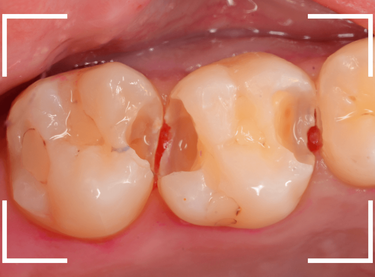 歯と歯の間の虫歯17-4