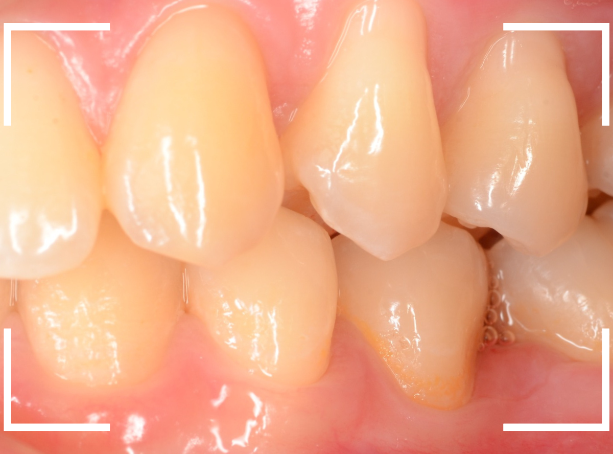 セラミック治療(インレー)23-7