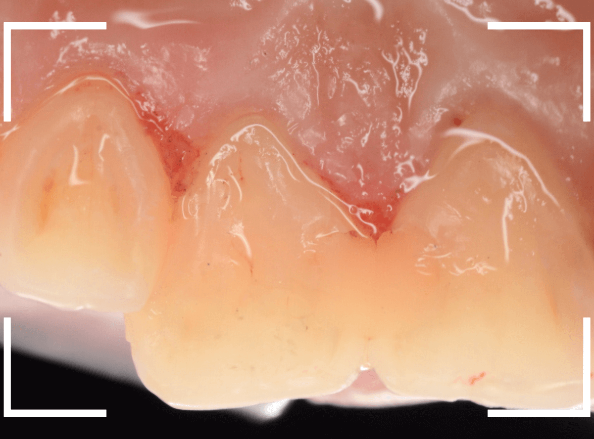 コンポジットレジン治療6-6